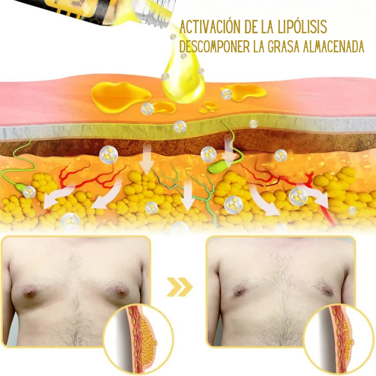 Men Therm Bee Venom Gynecomastia Heating Oil🐝🍯