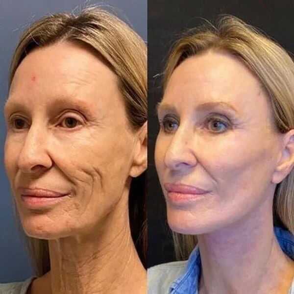 💉💧BOTOX FACE SERUM💧💉